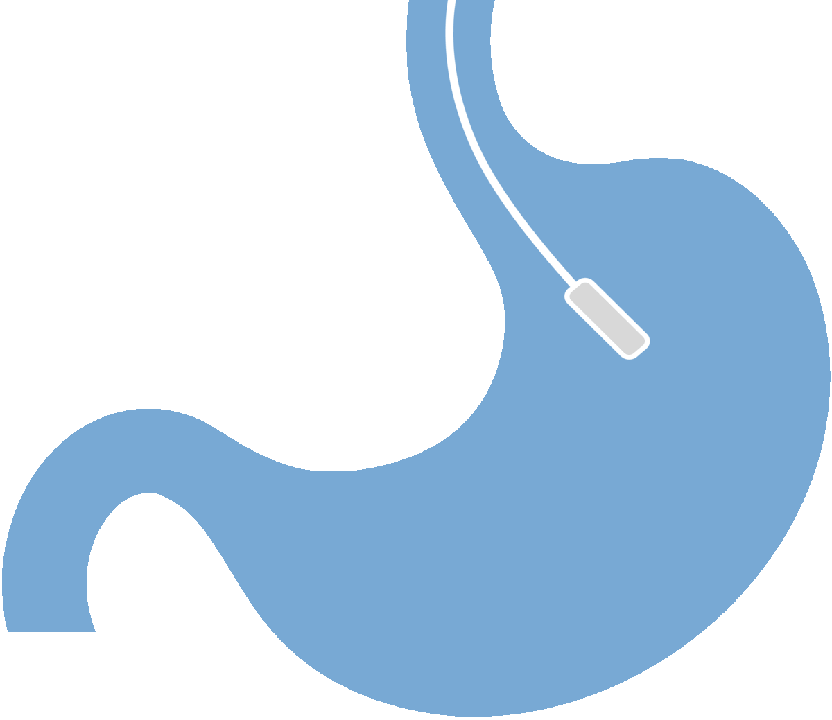 DUODENAL SWITCH