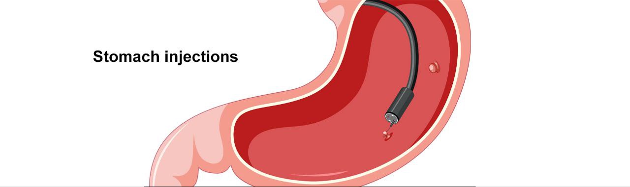 Duodenal Switch