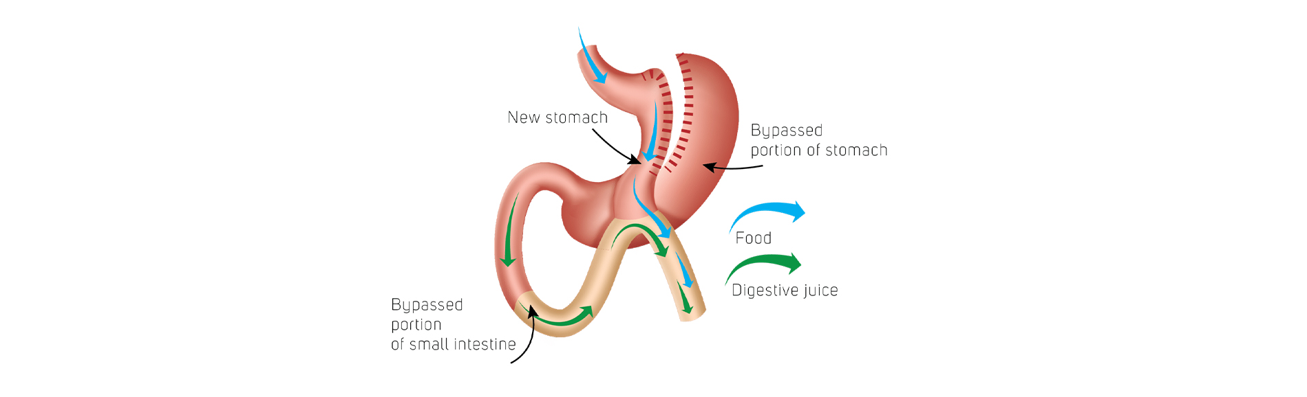 Duodenal Switch