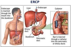 ERCP-Endoscopic Retrograde Cholangiopancreatography.